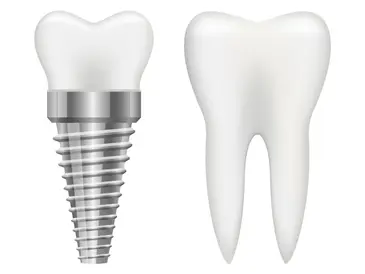 dental implant