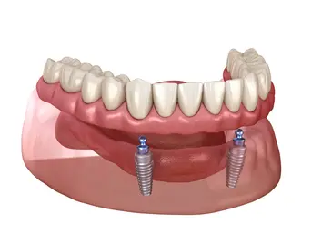 All on X Implant Dentures