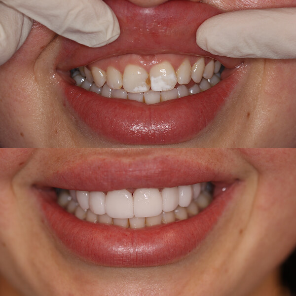 Mooroolbark dental implant