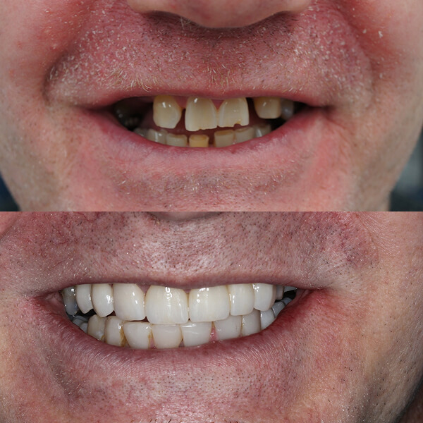 dental implant Mooroolbark dentists