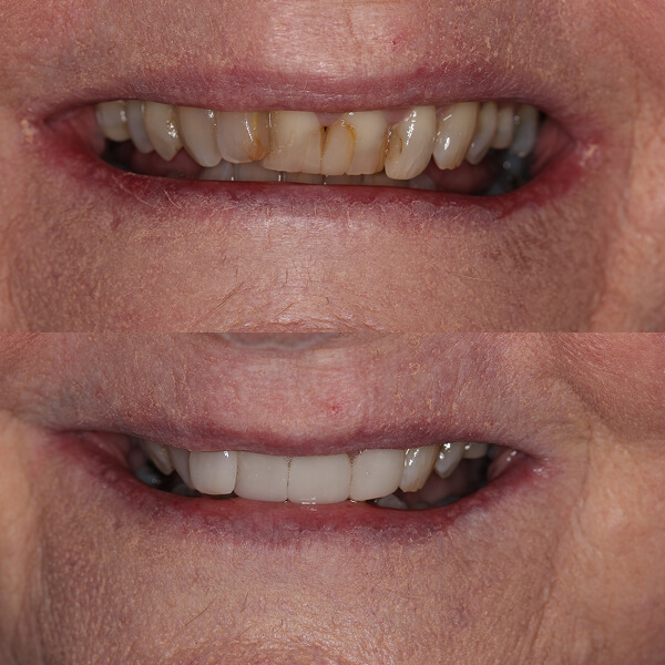 dental implant Mooroolbark