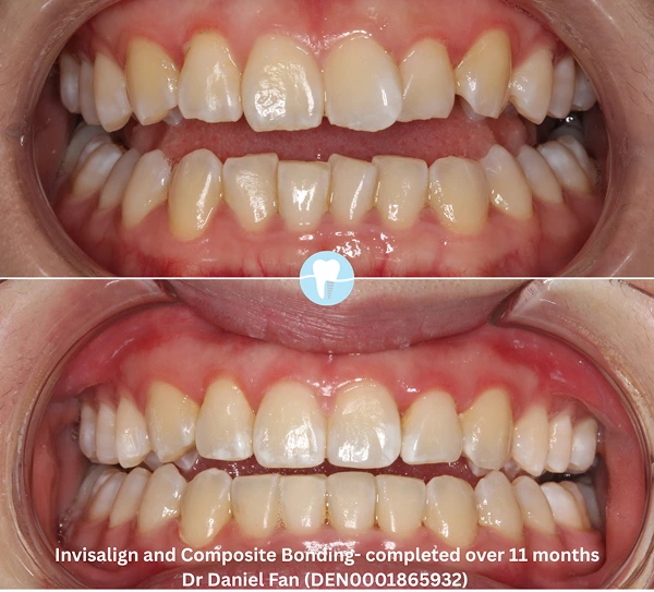 invisalign-composit-bonding before-after