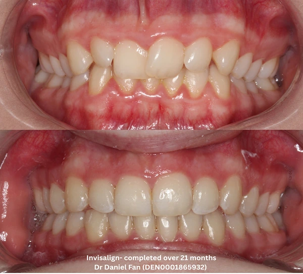 invisalign-composit-bonding before-after