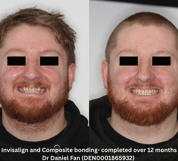 invisalign composit-bonding