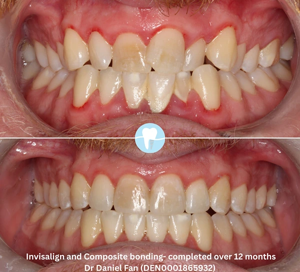 invisalign-composit-bonding before-after